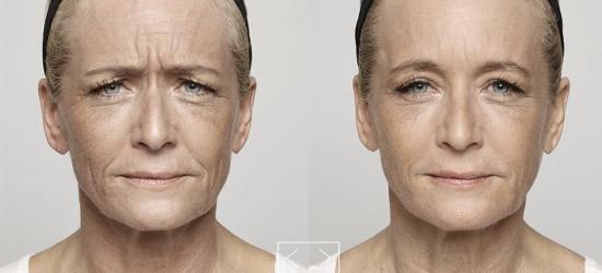 botox ráncfeltöltés vazelin anti aging